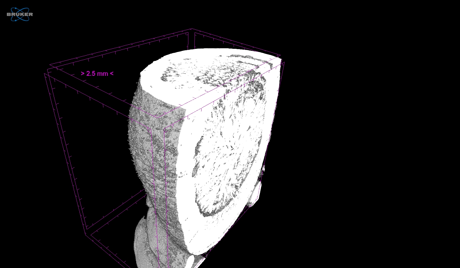 Черно-белая компьютерная томография фарфорового желчного пузыря и желчных камней внутри.