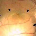 Close-up retinal image of the patient