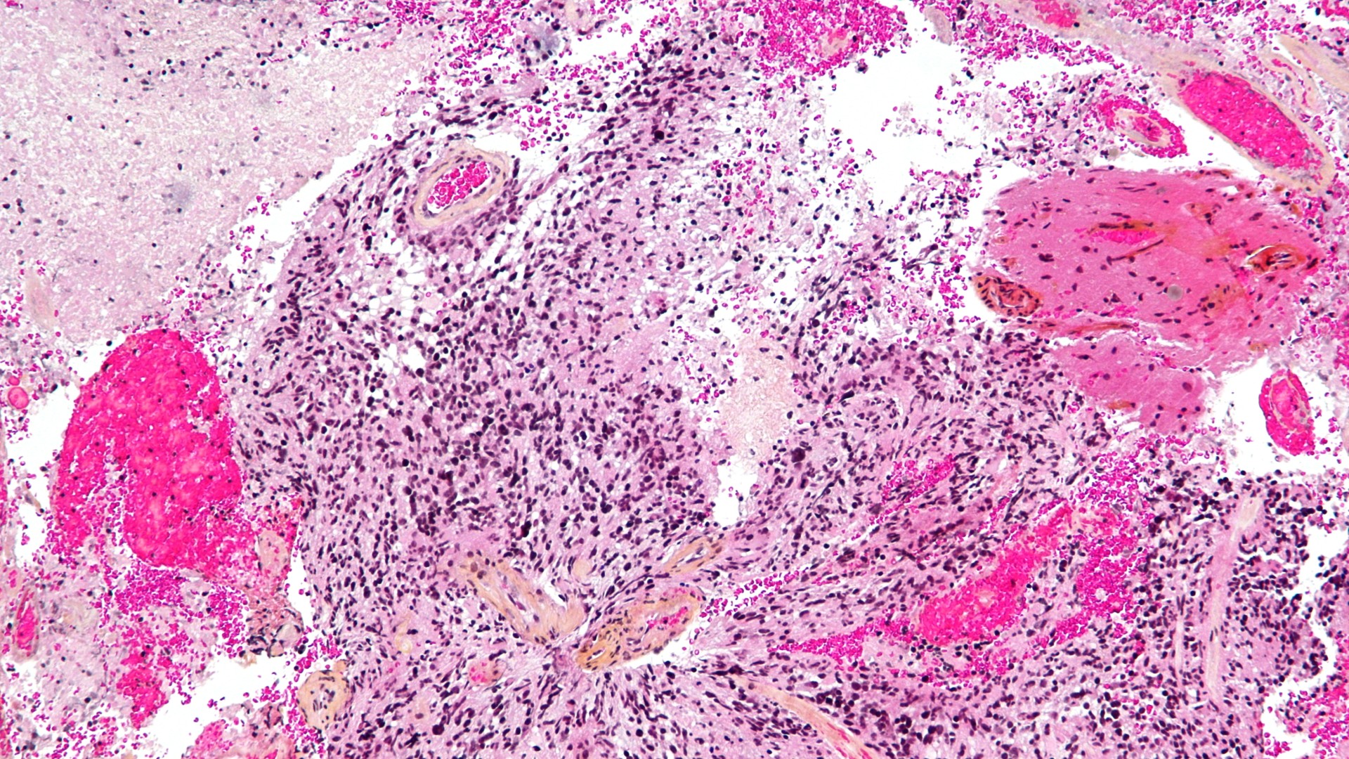 Разноцветное микроскопическое изображение глиобластомы под микроскопом.  Вокруг изображения разбросано множество черных пятен, с более крупными круглыми ярко-розовыми пятнами, а также более светло-розовыми и светло-желтыми пятнами разных форм/размеров.  Между ними видны белые просветы.