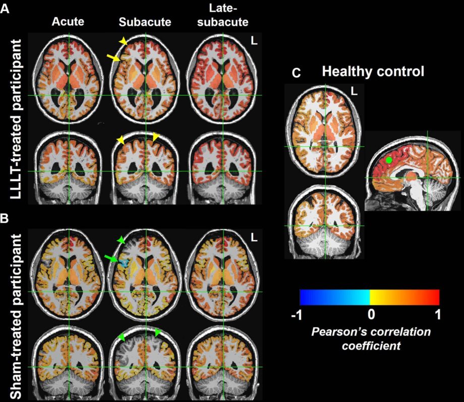 Исследование показало, что светотерапия улучшает связь мозга после травмы