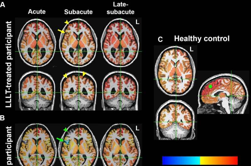 Светотерапия улучшает связь мозга после травмы