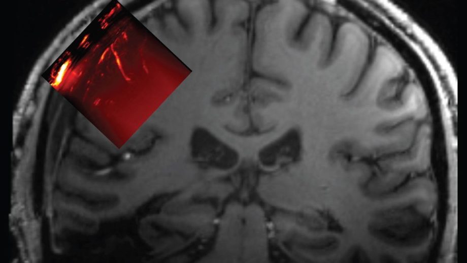 Ученые вставили окно в череп мужчины, чтобы прочитать его мозг с помощью ультразвука
